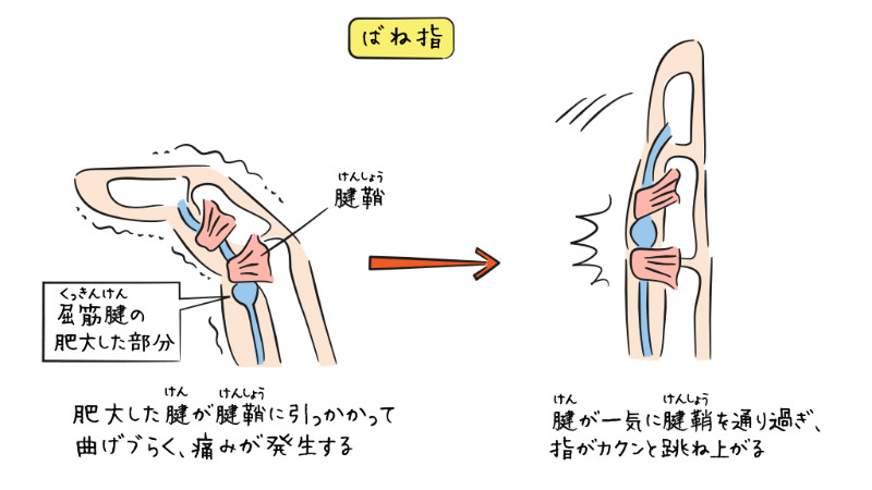 ばね指の解説