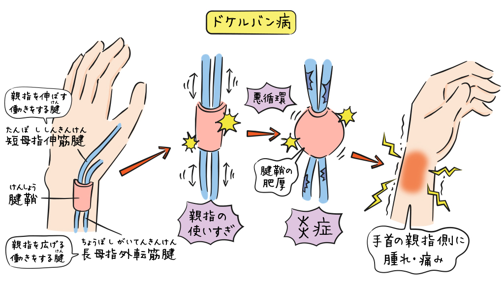 ドケルバン病の解説