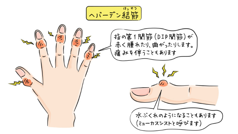 ヘバーデン結節の解説