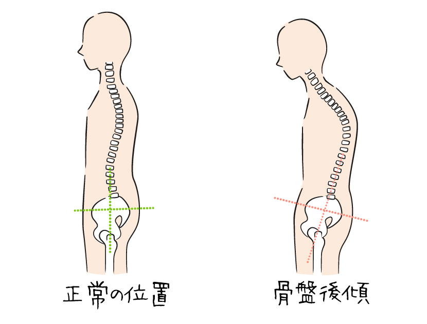 正常な骨盤の位置と骨盤後傾